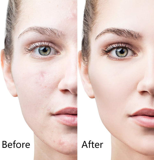 6-in-1 Derma Roller System - PERSP SMS